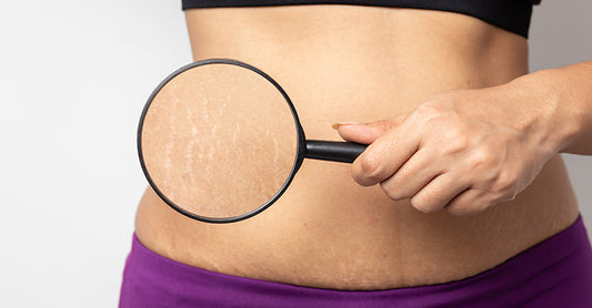 Want to Lighten Those Stretch Marks from Your Skin?