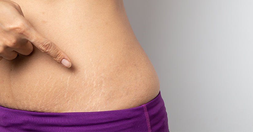 HOW TO GET RID OF STRETCH MARKS INFESTING YOUR SKIN